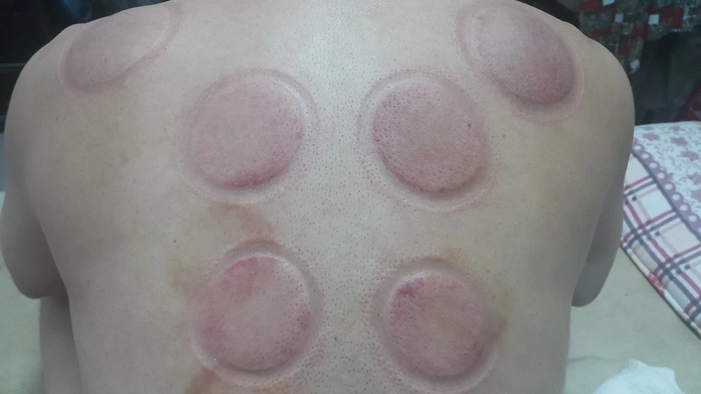 cupping therapy marks